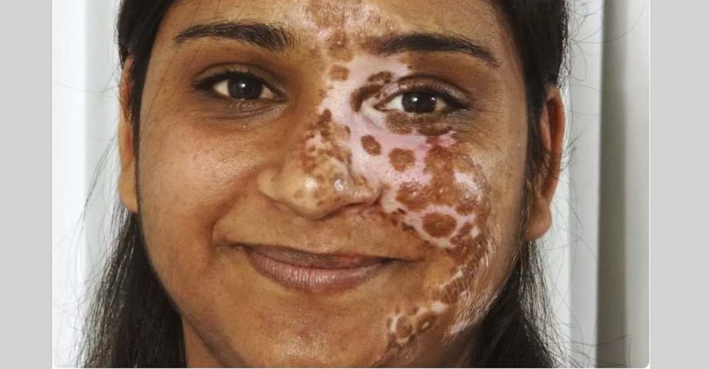 Vitiligo