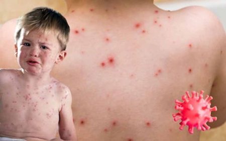 एचएमपीवी के बाद चीन में अब Mpox वायरस का नया स्ट्रेन मिलने से हाहाकार!, सरकार ने उठाए ये जरूरी कदम